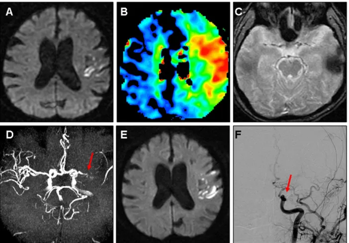 Figure 1. A 68-year-old man presented with mild aphasia, dysarthria and right arm weakness (NIHSS score = 4)