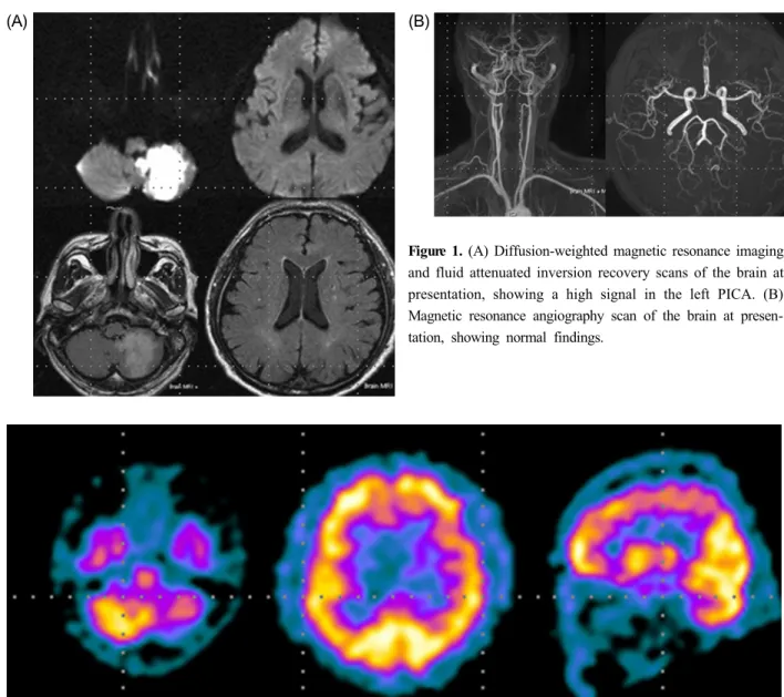 Figure 2. Brain single-photon-emission computed tomography at presentation, showing hypoperfusion in the left cerebellar and  frontal cortex.