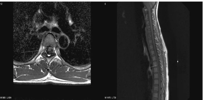 Figure 1. Initial cervicothoracic spine MRI showing anterior displacement of spinal cord at the level of the T4-5 disc (arrows).