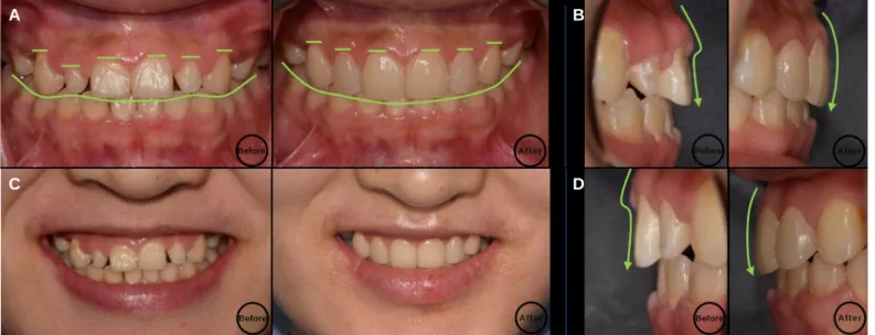 Fig. 30. Comparison of before and after treatment. (A) Frontal view, (B) Right lateral view, (C) Maxillary anterior view, (D) Left lateral view