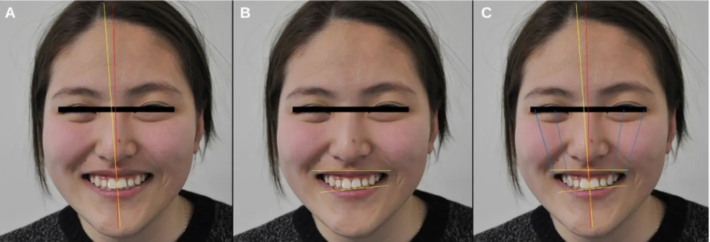 Fig. 1. Initial extra-oral photographs in frontal view. (A) Facial midline with the midline of central incisors, (B) Horizontal parameters relating the inter-pupillary line to the incisal edge position, (C) Full-facial analysis.