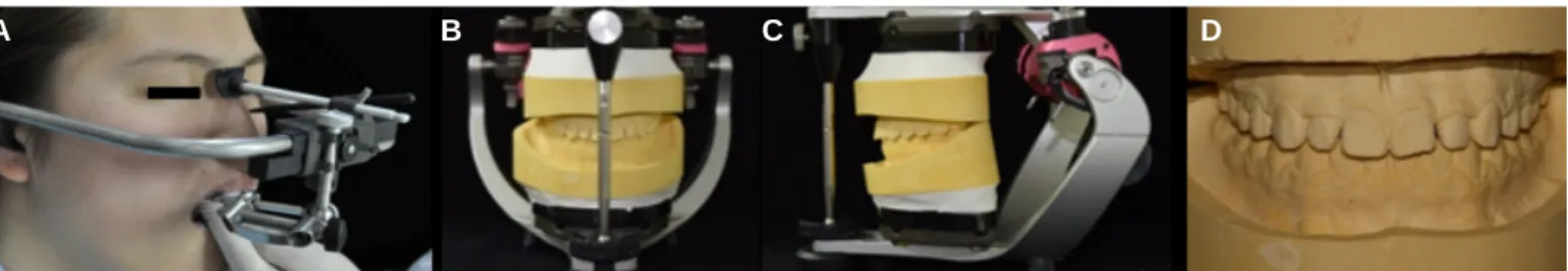 Fig. 7. Semi-articulator mounting procedures. (A) Facebow transfer (B) Mounting the diagnostic model to an articulator in frontal view (C) Mounting the diagnostic mod- mod-el to an articulator in lateral view (D) Diagnostic modmod-el.