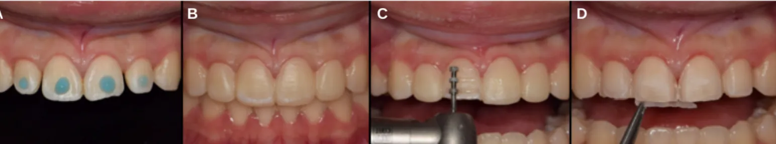 Fig. 12. Mock-up fabrication and abutment preparation. (A) Spot etching, (B) Mock-up fabircation, (C) Abutment preparation, (D) Removal of resin excess.