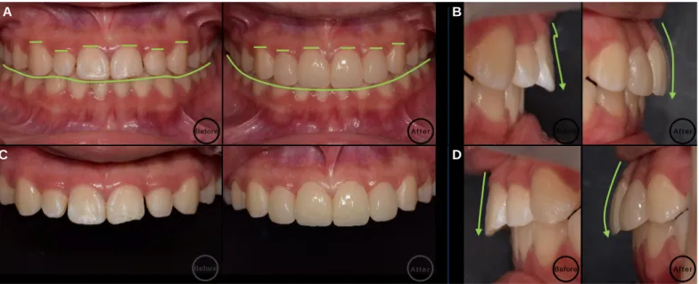 Fig. 16. Comparison of before and after treatment. (A) Frontal view, (B) Right lateral view, (C) Maxillary anterior view, (D) Left lateral view.