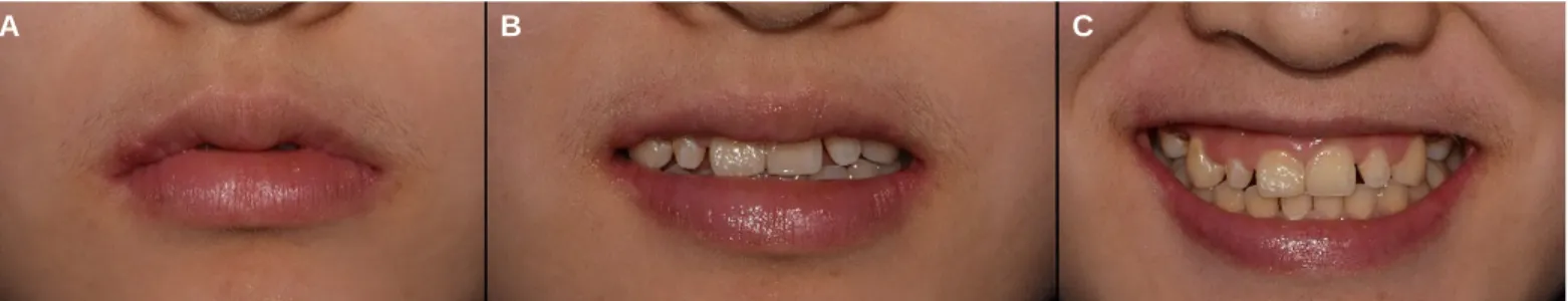 Fig. 22. Analysis of smile line at initial visit. (A) Rest state view, (B) Slight smile view, (C) Maximum smile view.
