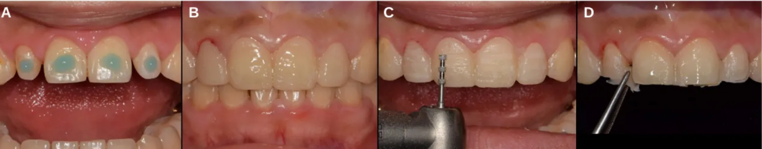 Fig. 26. Mock-up fabrication and abutment preparation. (A) Spot etching, (B) Mock-up fabircation, (C) Abutment preparation, (D) Removal of resin excess.