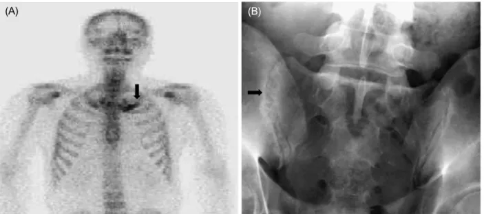 Figure 2.  99m Tc methylene diphosphonate whole-body bone scan showed active lesions in the left costomanubrial junction and first  rib (arrow) (A)