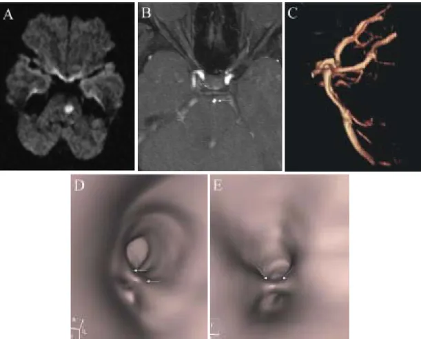 Figure 1. Imaging of a 55-year-old woman with acute pontine infarction. (A) Diffusion-weighted MR image with hyperintense signals in the left pons