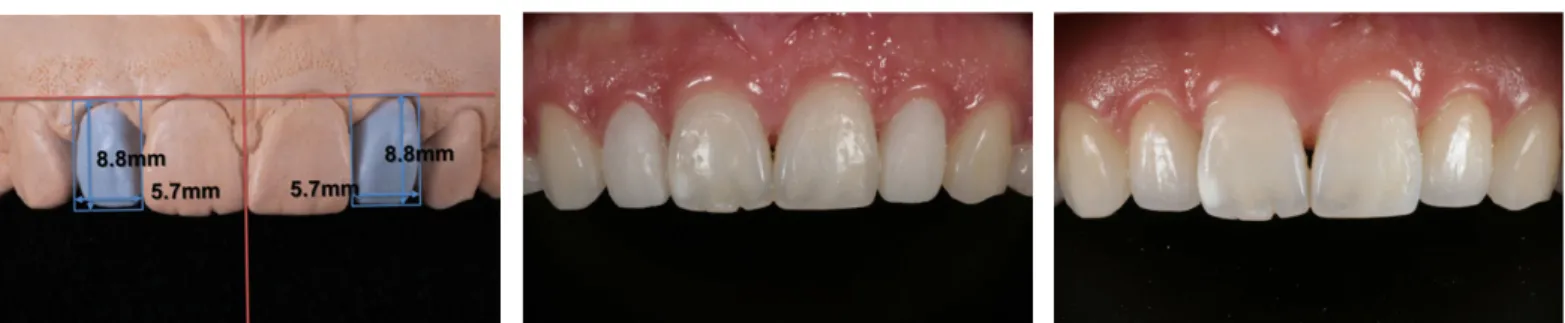 Fig. 5. Diagnostic wax-up. Fig. 6. Interim restoration. Fig. 7. Definitive restoration.