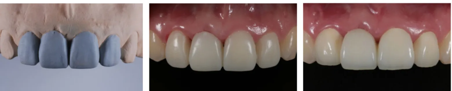Fig. 10. Diagnostic wax-up. Fig. 11. Interim restoration. Fig. 12. Definitive restoration.
