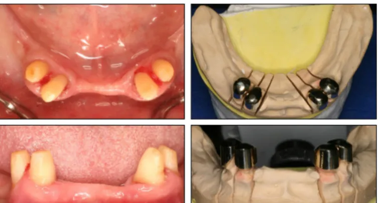 Fig. 4. Temporary denture delivery.