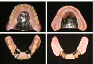 Fig. 8. Definitive prosthesis.