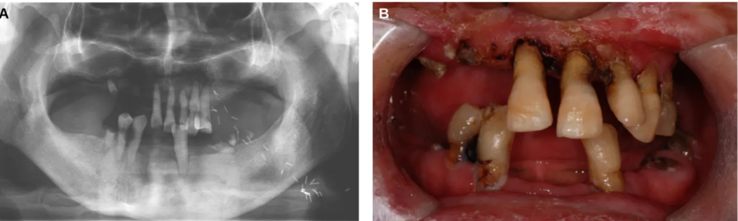 Fig. 2. Maxillary impression with conventional method.