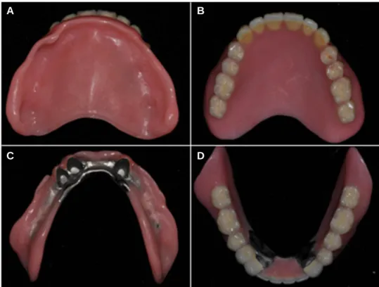 Fig. 5. (A, B) Maxillary complete denture, (C, D) mandibular double crown RPD.