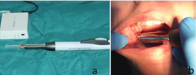 Fig. 1. QuickSleeper device has been set up (a) Anesthetic solution is deposited in the distal cancellous bone adjacent to the mandibular third molar tooth to be anesthetized (b)