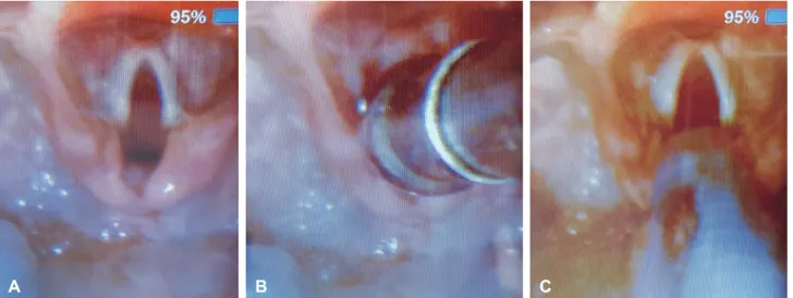 Fig. 2. A: Field of view using video laryngoscopy. A small epiglottis and vocal cord are visible