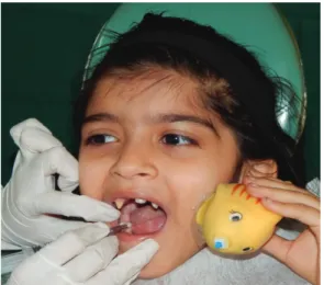 Fig. 5. This figure shows the administration of local anesthesia using the