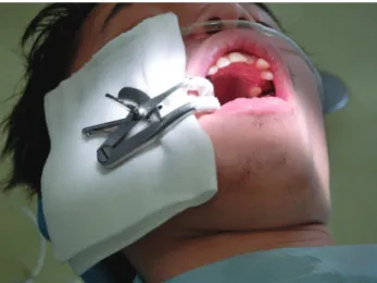 Fig. 1. Nasal cannula and mouth gag: patient movement was observed  when the nasal cannula and mouth gag were inserted in the dental  procedure.
