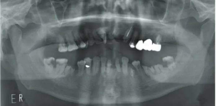 Fig. 2. A: Panoramic view of the implant on 2 nd  operation (2015.04.16), B: Right maxillary and mandibular part, C: After the 2 nd  operation