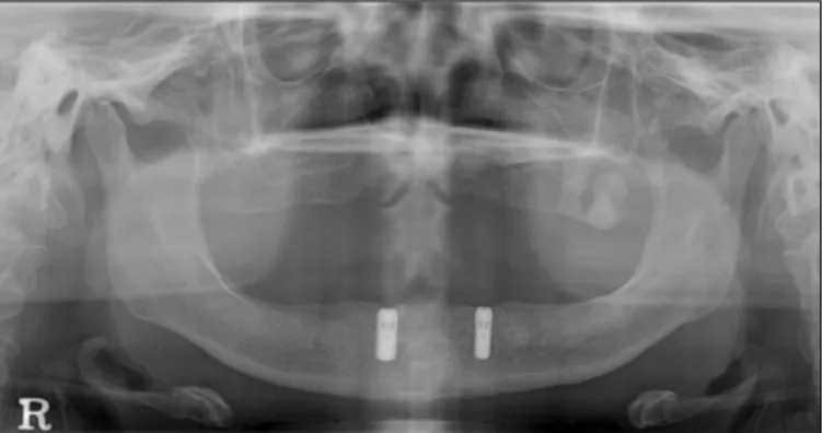 Fig. 1. Panoramic radiograph at first visit. Fig. 3. Panoramic radiograph after implant installation.