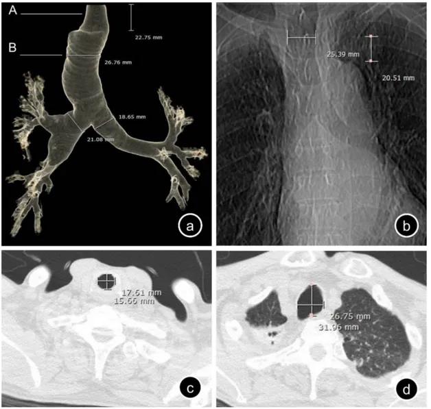 Fig. 1. (a) Anteroposterior view of the three-dimensional reconstruction of the thoracic computed tomography (CT) images