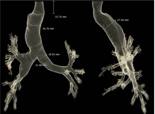 Fig. 2. Three-dimensional reconstruction of the preoperative thoracic computed tomography images showing severe dilation of the trachea and mainstem bronchi