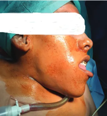 Fig. 5. Oral submental intubation.