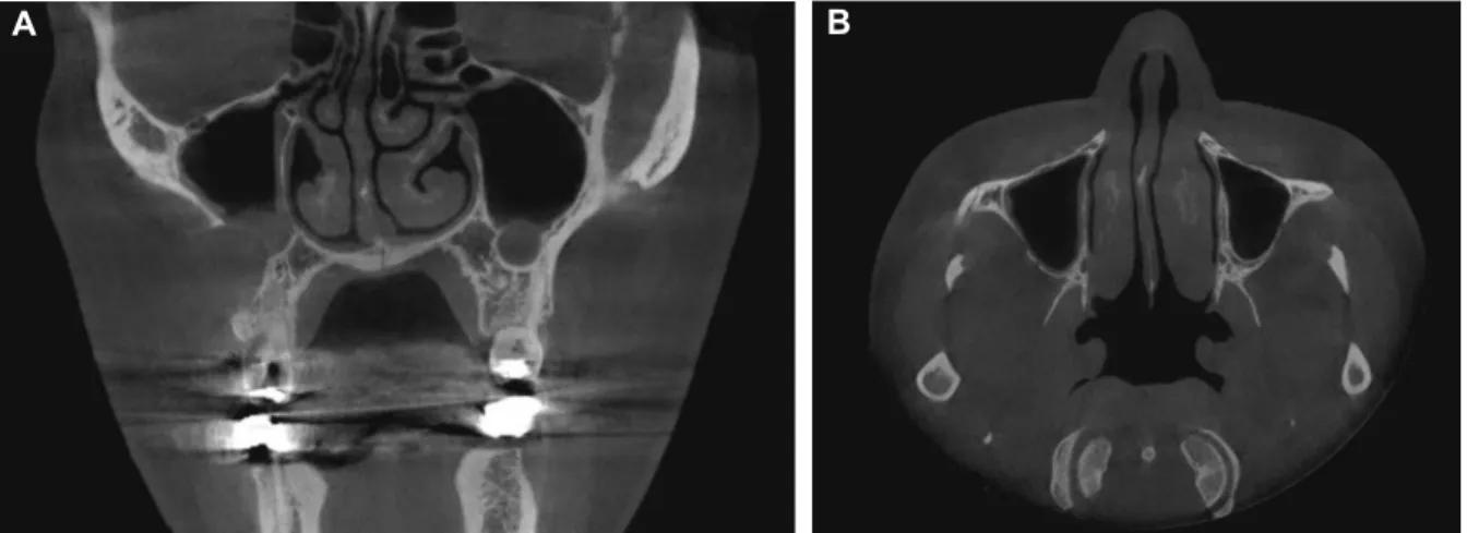 Fig. 1. Preoperative dental computed tomography showing a radicular cyst in the right maxilla and a mucocele in the left maxilla