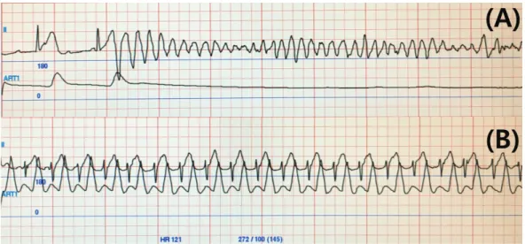 Fig. 4. Changes in lead II on electrocardiogram and arterial blood pressure during anesthesia