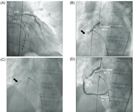 Fig. 6. Coronary angiography and percutaneous coronary intervention. (A) Normal left coronary angiography (RAO 7.1 CAU 28.9), (B) Angiography showing complete luminal occlusion of the mid RCA (arrow) (LAO 29.4, CAU 0.6), (C) Successful wiring to distal RCA