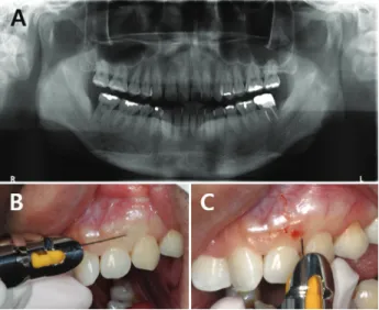 Fig. 3. Intraosseous anesthesia administration in the left maxillary area: