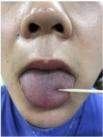 Fig. 1. The patient complained of paresthesia and loss of taste in the anterior two thirds of the tongue