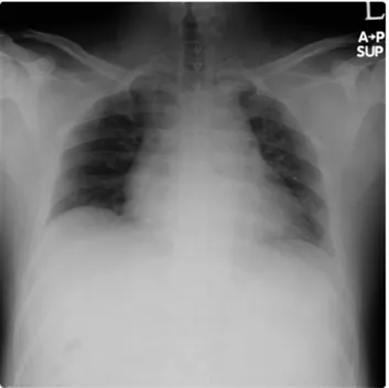 Fig. 2. Chest Radiograph shows normal lungs. Fig. 3. Bronchoscopic image shows crescent type of collapsed trachea.