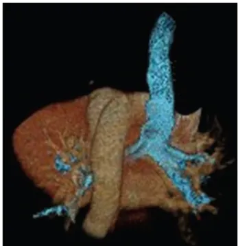 Fig. 4. Oblique coronal reconstructed image shows prominent aortic arch (arrow) and focal indentation and luminal narrowing of trachea (arrowhead) due to extrinsic compression