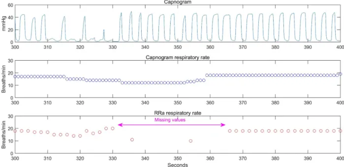 Fig. 1. Stored capnogram wave was confirmed, and the numbers of respiratory rates with capnogram and acoustic respiration rate (RRa) were extracted  at  2-s  intervals