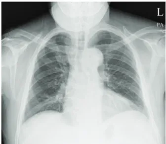 Fig. 1. Preoperative Chest X-ray image. No active pulmonary parenchymal  lesions or nodular masses can be observed in either lung.