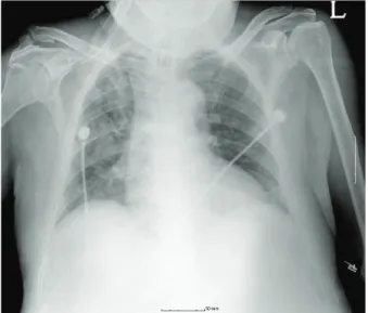 Fig. 3. Chest X-ray image obtained 6 hours after suctioning. The right  upper lobe collapse is improved, but subtle remnant parenchymal opacity  is visible in the right lung.