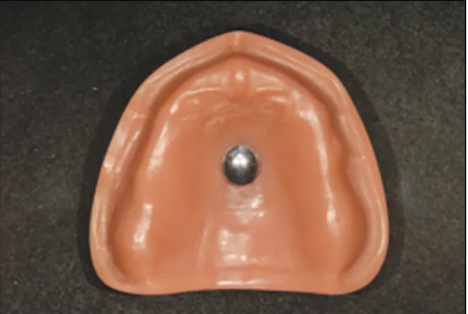 Fig. 1. Edentulous model with recess for ball attachment.