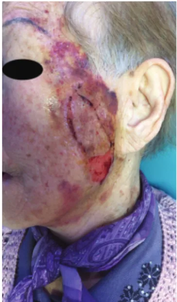 Fig. 2. After 5 days, bruising is worsened, but secondary healing is  occurring.