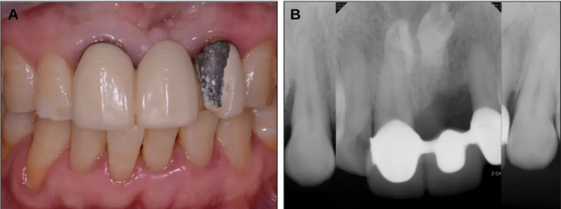 Fig. 1. A: Frontal view before treatment, B: Periapical view before treatment.