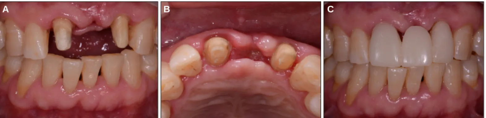 Fig. 4. Initial view of gingival contour. A: Frontal view, B: Occlusal view, C: provisional restoration.