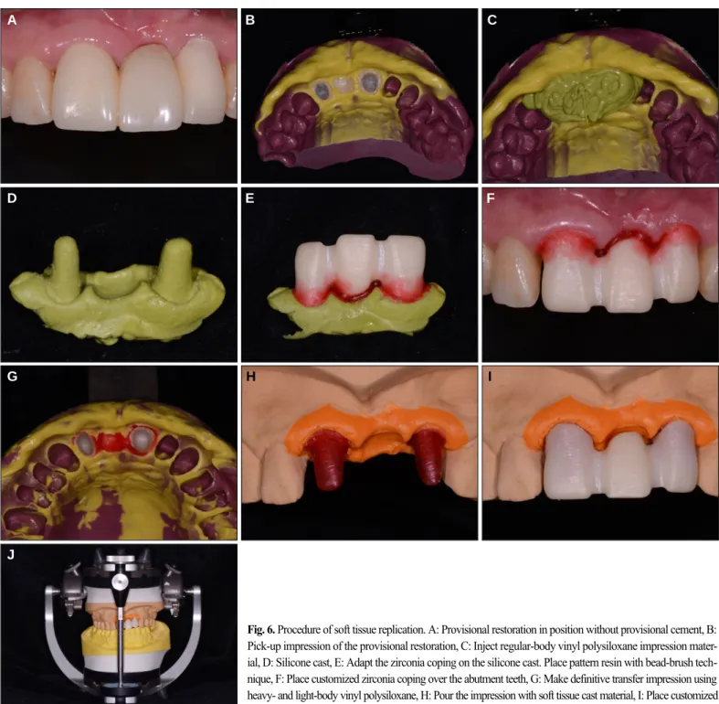 Fig. 6. Procedure of soft tissue replication. A: Provisional restoration in position without provisional cement, B: