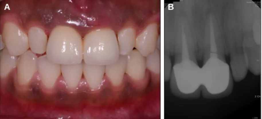 Fig. 7. A: Intraoral view of the final prosthesis, B: Final prosthesis, C: Two months after gingival sculpturing, D: