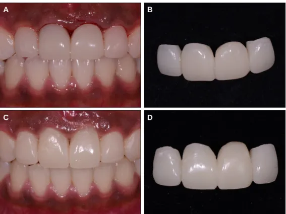 Fig. 10. A, B: Immediate after extraction, C, D: Two months after gingival sculpturing.