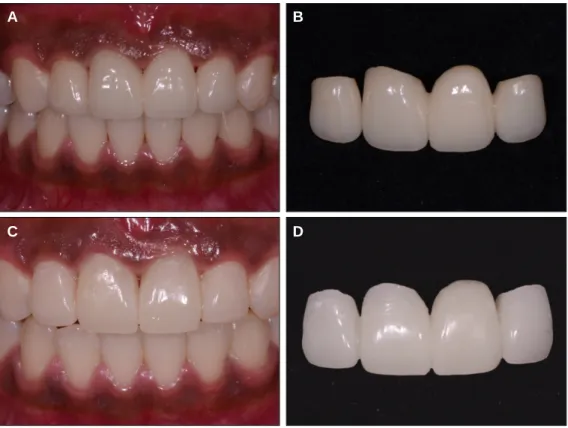 Fig. 12. A: Intraoral view of the final prosthesis, B: Final prosthesis, C: Two months after gingival sculpturing, D: