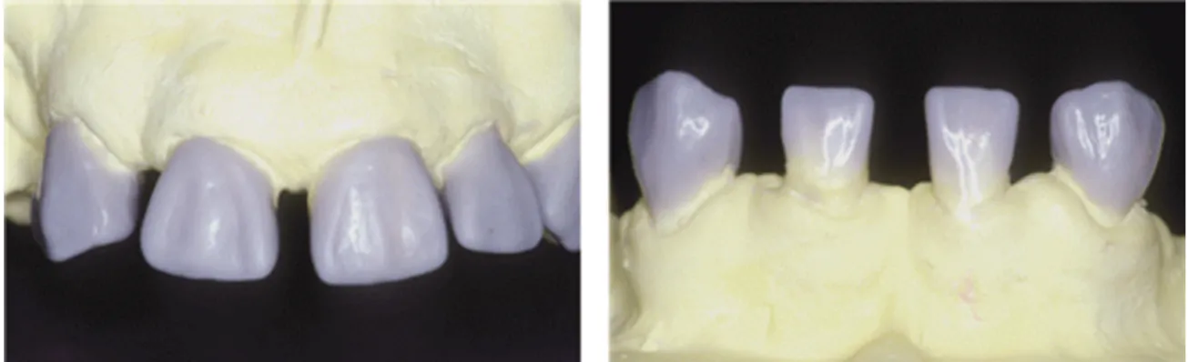Fig. 3. Diagnostic wax-up with proper crown contour and ratio.