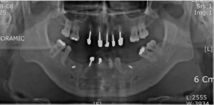 Fig. 5. Panoramic radiograph after endodontic treatment on maxillary anterior teeth and bone graft on mandibular defect area