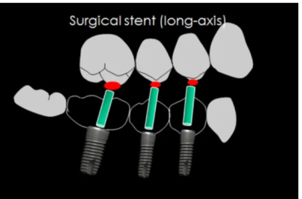 Fig. 12. Direction of implantation should be parallel to the long axis of opposing teeth.