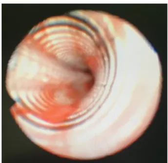 Fig. 1. Fiberoptic bronchoscopic view of the inside of the endotracheal tube. A longitudinal fold is seen inside the tube.