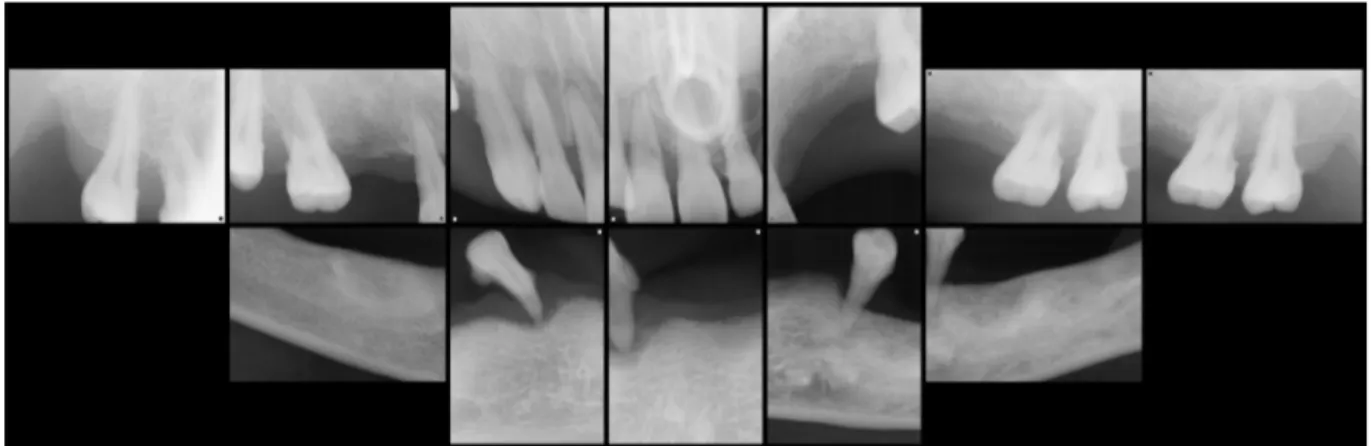 Fig. 1. The pre-operative full mouth intraoral radiograph obtained under general anesthesia.